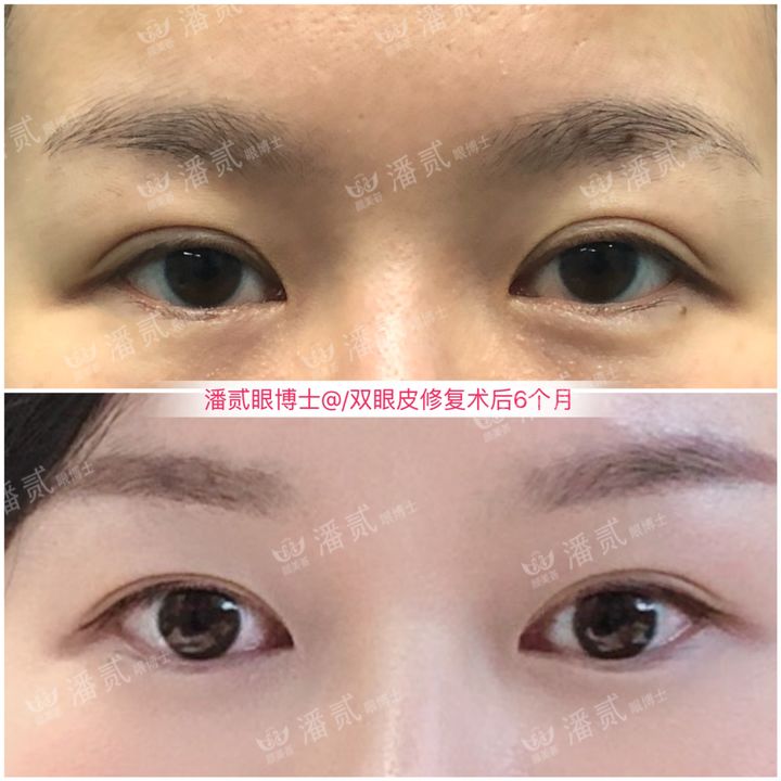 韩式精雕微创双眼皮,韩式微创双眼皮恢复过程真实记录