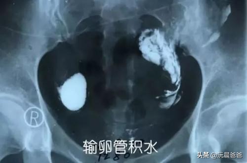 多囊卵巢造影能查出怀孕吗,多囊卵巢造影