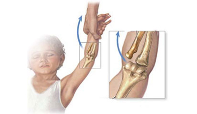 尺桡骨骨干骨折,如何区分尺桡骨骨折类型