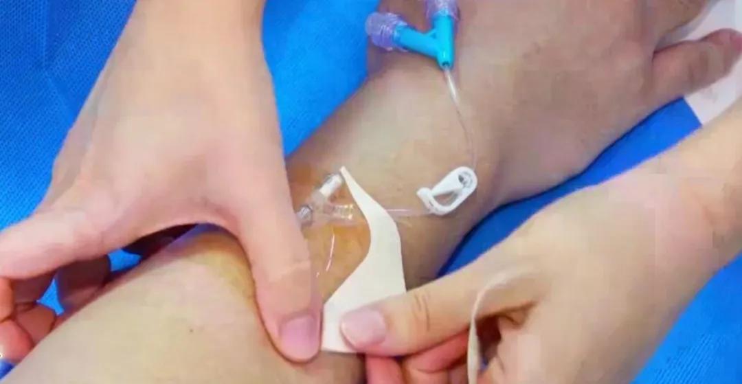 留置针软管断裂有什么症状,留置针的软管断在里面怎么办