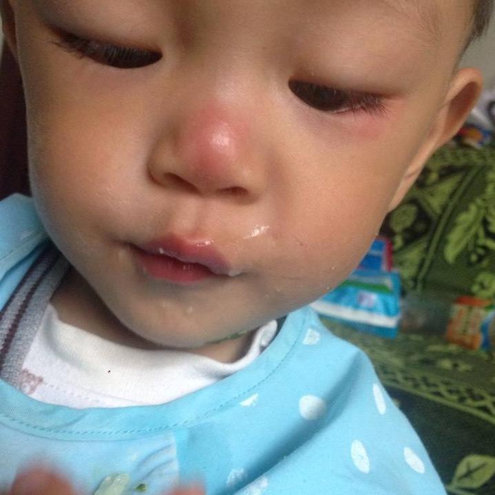 流鼻涕时的必备知识,春季孩子有点流清鼻涕喝点什么药