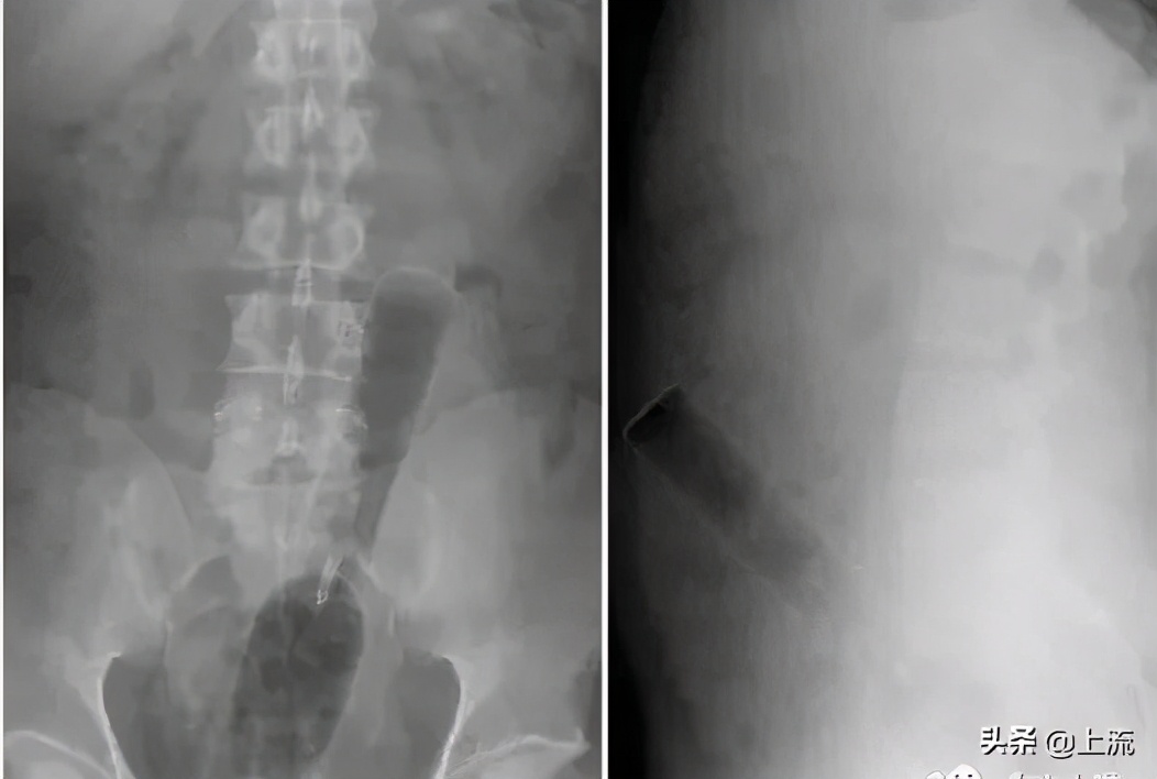 肛肠科医生的手指为什么这么粗,肛肠科医生用手指做检查