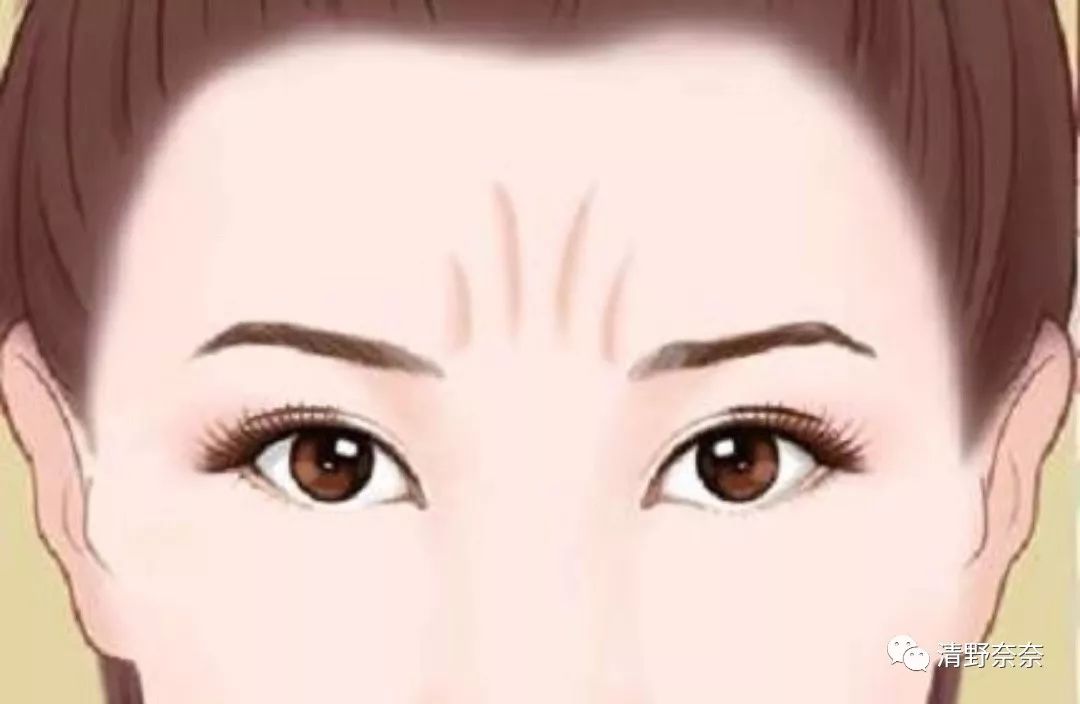 改善法令纹和川字纹抬头纹医美,祛除法令纹鱼尾纹最佳医美方法