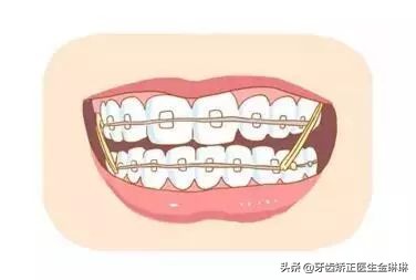 淄博矫正牙齿一般多少钱,淄博牙齿矫正一般多少钱