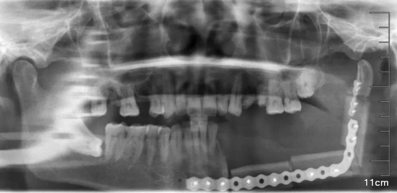 嚼槟榔到底有多大的危害,槟榔的毒性到底有多强