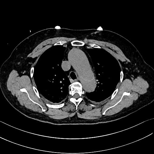 胸部Ct平扫能查出主动脉夹层吗,主动脉夹层cta影像图片解读
