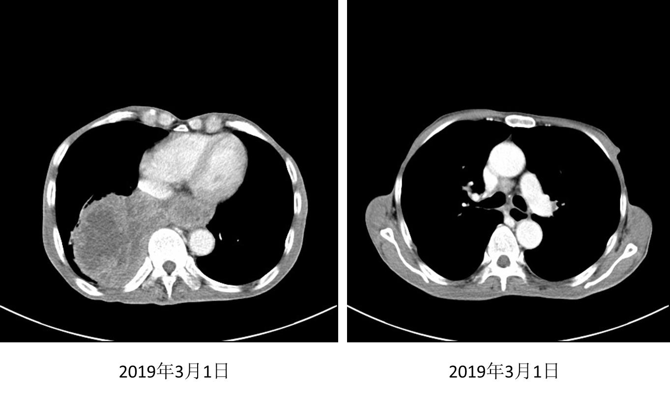 信迪利单抗治疗肺鳞癌效果,信迪利单抗治疗肺鳞癌晚期