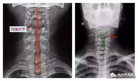 一天教会你美式整脊,美式整脊的两个派系