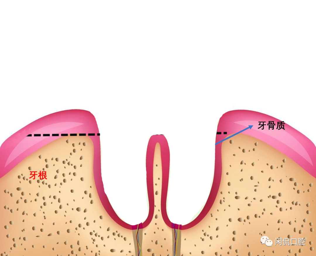 拔完牙出血快速止血妙招,拔完牙吐了棉球还出血正常吗
