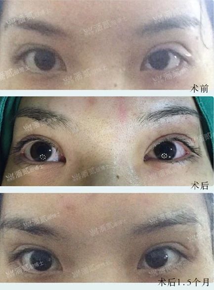 双眼皮失败的女孩,双眼皮失败做成了三眼皮好修复吗