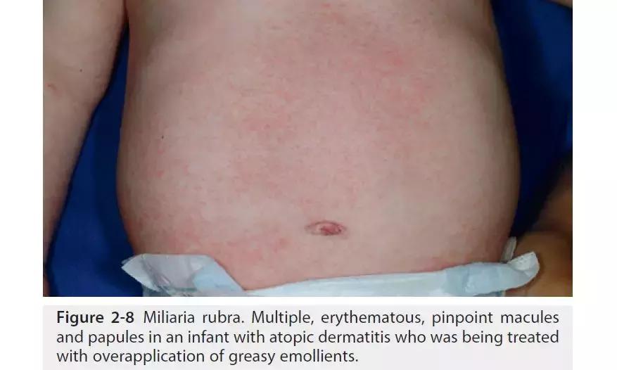 新生儿皮肤问题大全一览表,新生儿常见八大皮肤问题