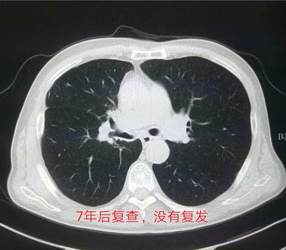 与肺癌病人一起生活需要注意什么,与肺癌抗战的第七个月