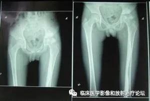 蜡泪样骨病发展缓慢,蜡泪样骨病影像表现