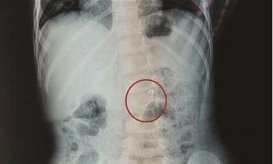 7个月孩子误吞别针,一岁女童误吞别针