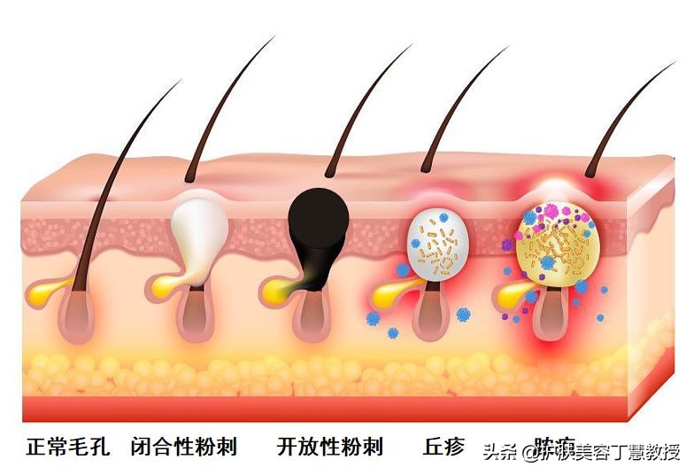 三招教你搞定痘痘肌,教你三招小技巧轻松解决痘痘烦恼