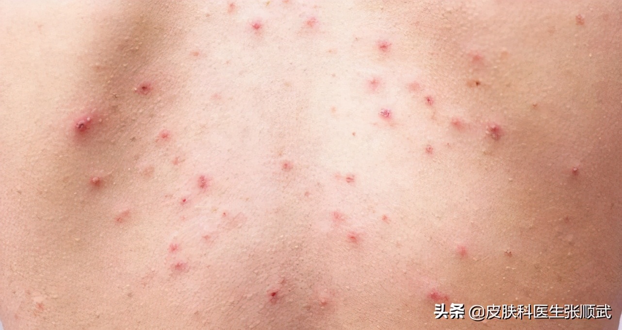 前胸后背长毛囊炎可以自愈吗,背部长毛囊炎怎么消除