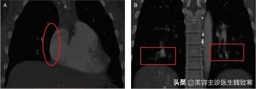 私密整形严重并发症:阴道注射填充剂9小时后永久停止呼吸