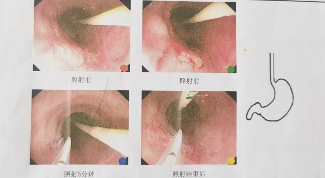 介入治疗食道癌成功案例,最新前沿治疗肿瘤技术