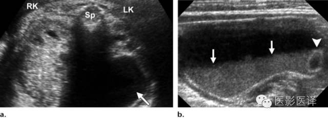 胎儿卵巢囊肿5.6厘米会消失吗,卵巢巨大囊肿与妊娠鉴别