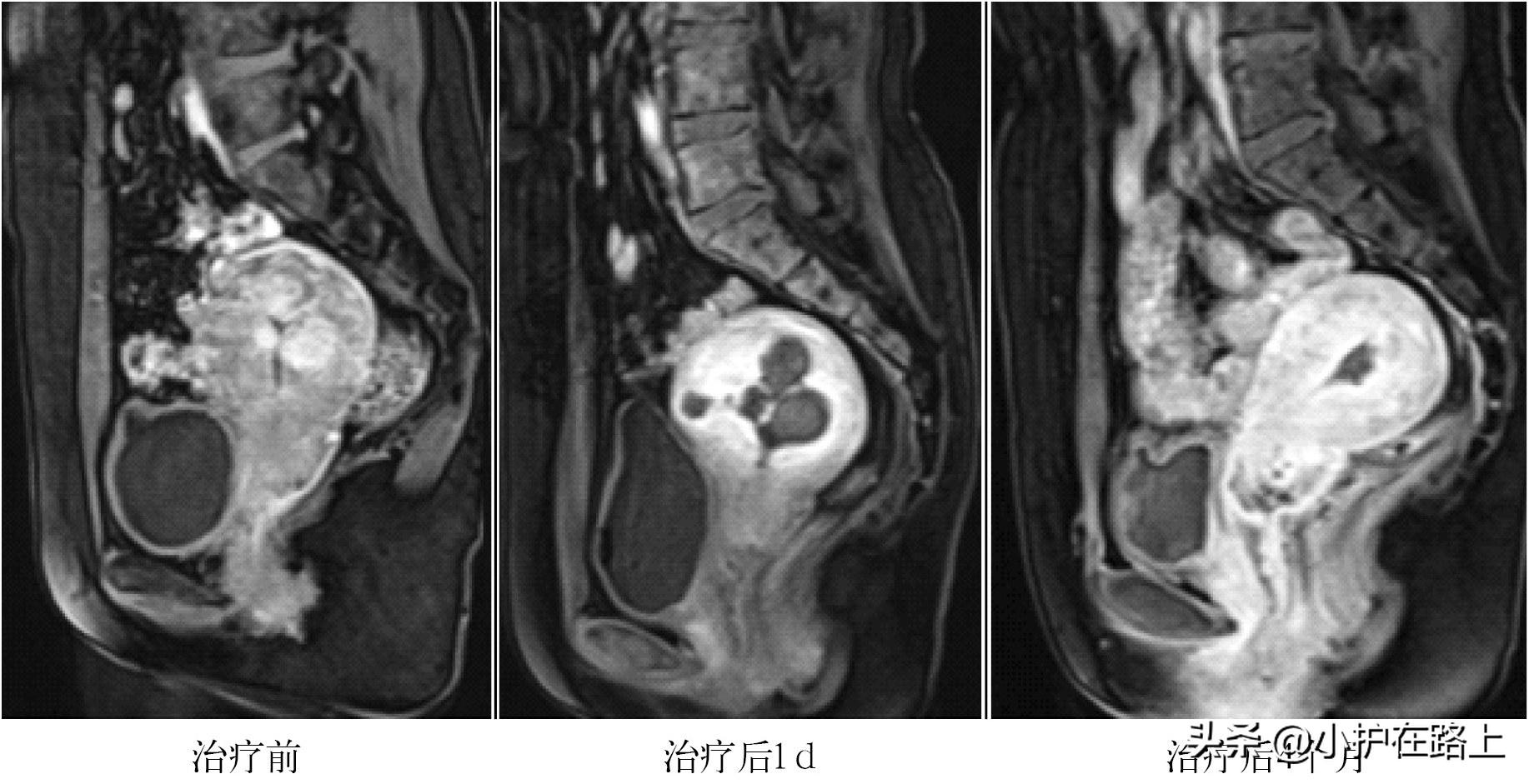 聚焦超声子宫肌瘤会复发吗,子宫肌瘤聚焦超声消融手术会痛吗
