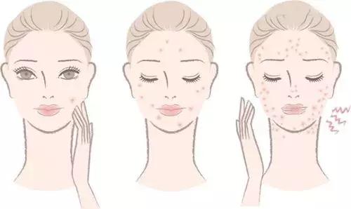 有什么祛痘印的方法,祛红痘印最好的方法