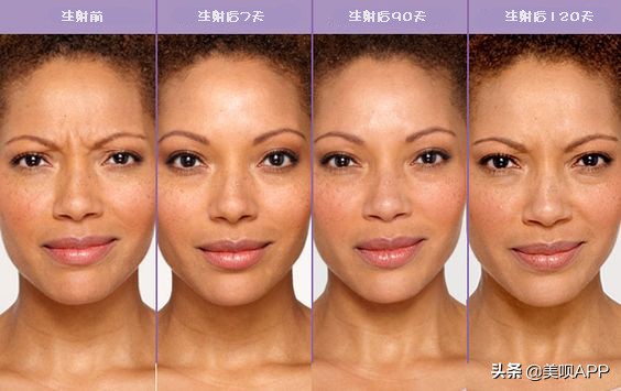 西京医院整形美容科面部年轻化,面部美容年轻化手术科普