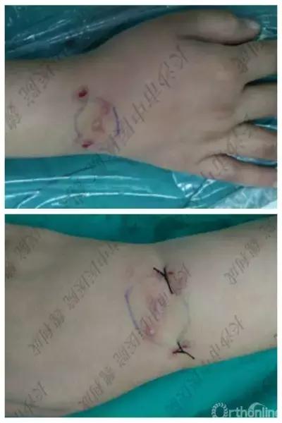 手腕囊肿抽吸出来后可否继续按压,足背囊肿穿刺好还是切除好