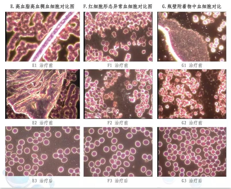 臭氧血疗法对脑梗有用吗,臭氧疗法脑梗塞