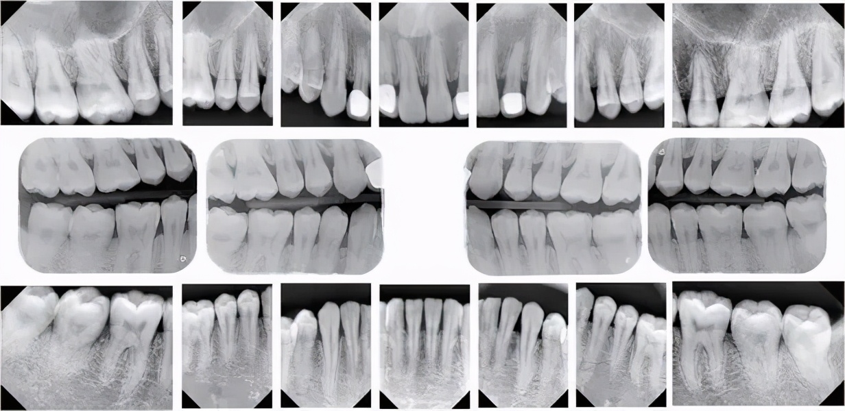 常见的儿童牙齿疾病有哪些,孩子牙齿的问题