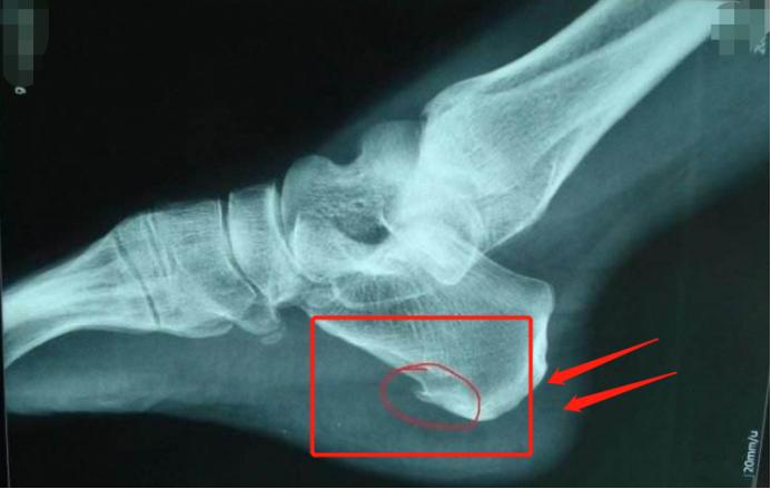 上班站12个小时脚后跟疼怎么缓解,女性膝盖脚后跟疼痛可能有三种病