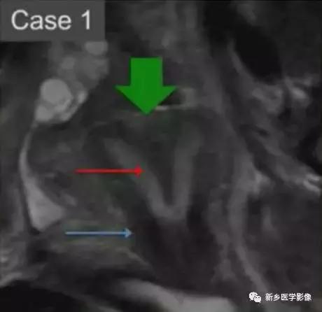 子宫发育异常,应想到的6大类常见畸形