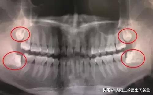 拔牙有什么好方法吗,拔牙有什么好办法不痛