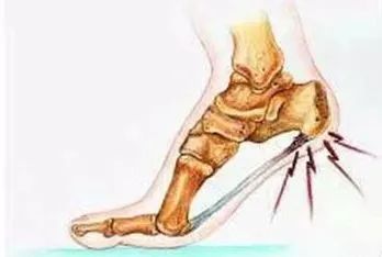 治疗足跟骨刺南阳,骨科康复医学科普骨刺