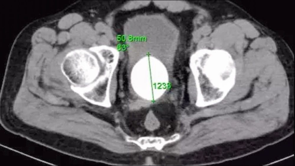 龙文:夏季结石高发,三院医生教你如何预防!