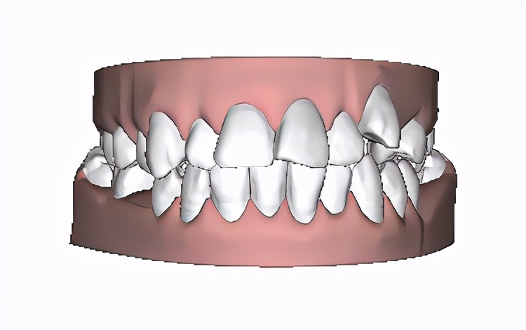 13岁儿童牙齿矫正龅牙前突,牙齿前突龅牙治疗过程