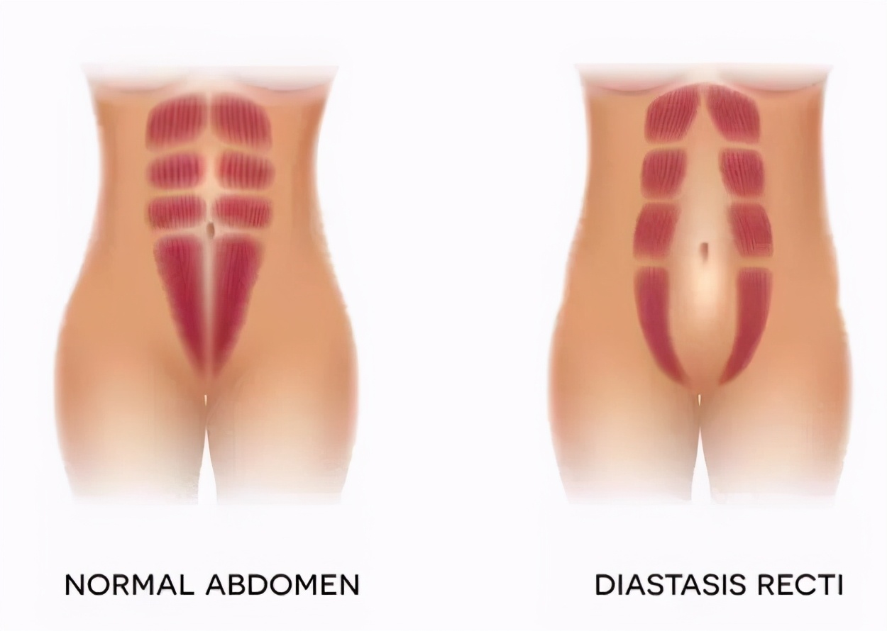 三指半到闭合,一个双胞胎妈妈的腹直肌康复之路