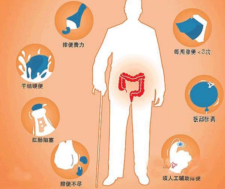 顽固便秘肠胃不蠕动,注意日常生活习惯便秘不再是难题