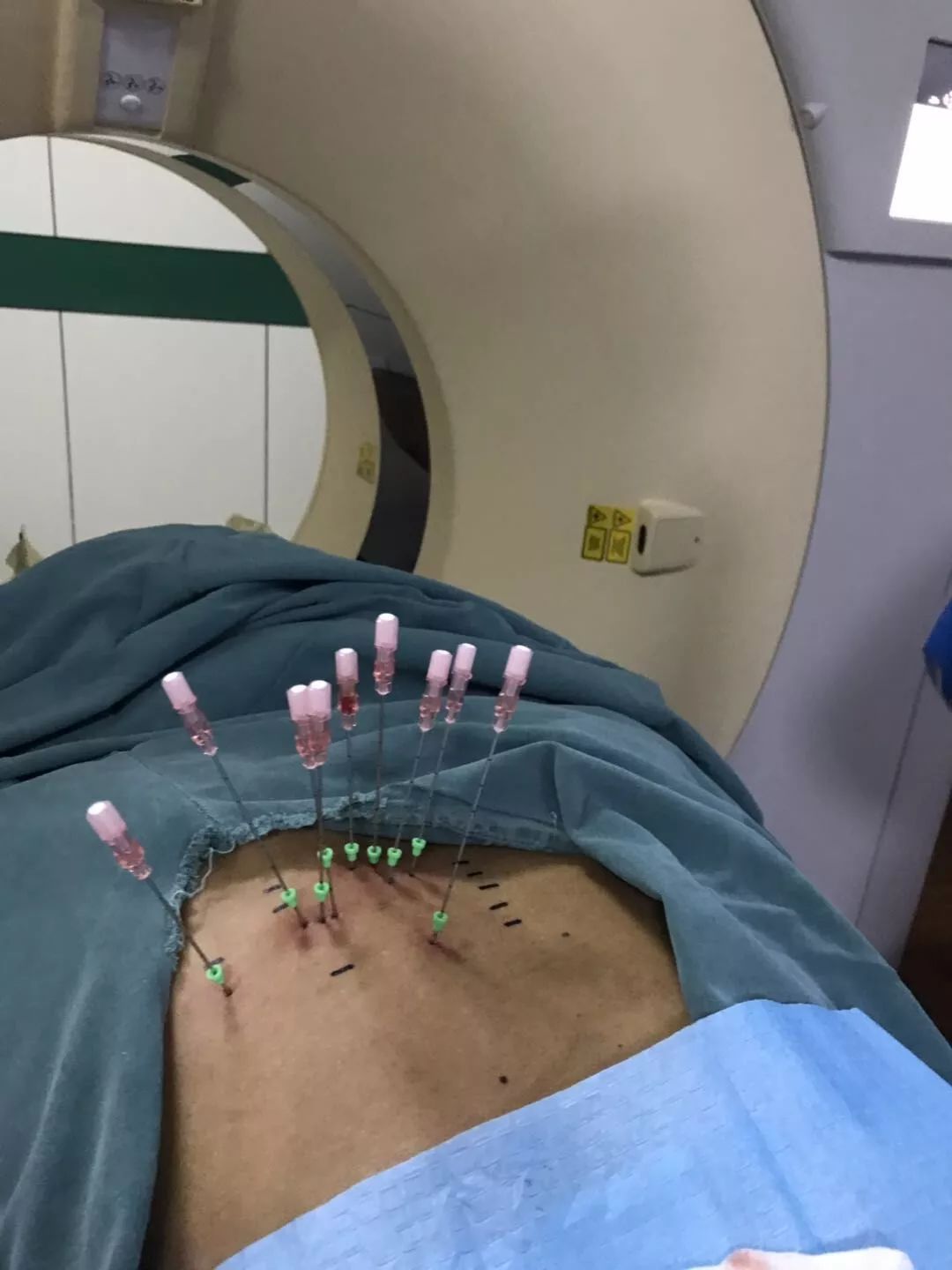 晚期肺癌患者，应用粒子植入术，抗癌案例分享