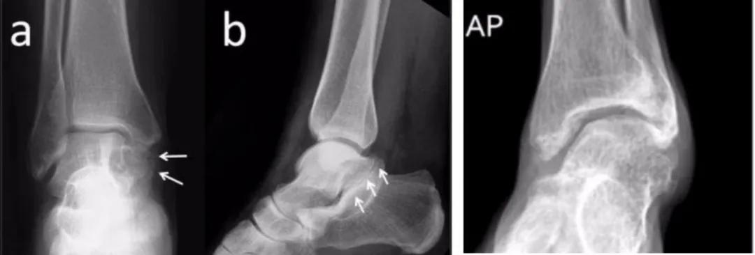 小孩玩多了脚酸脚痛怎么回事,小孩子玩着玩着就脚痛