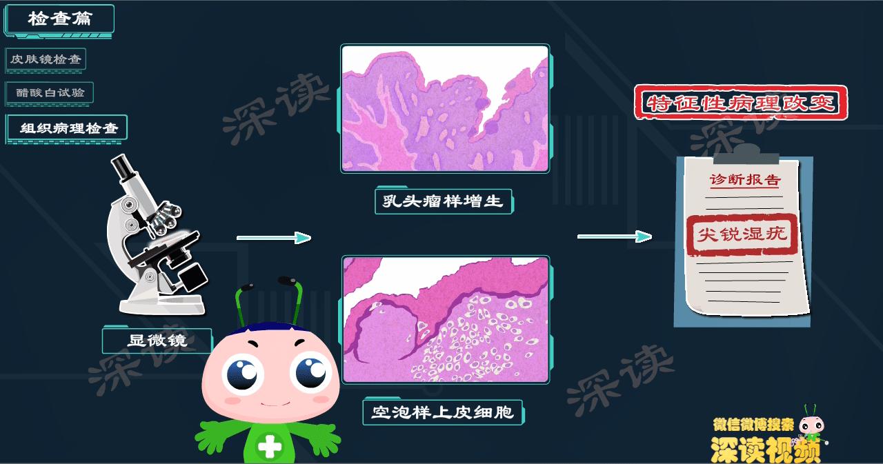 液氮冷冻治疗尖锐湿疣没感觉,液氮冷冻治疗尖锐湿疣注意事项