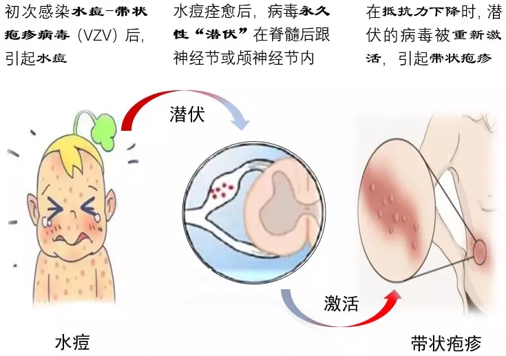什么抗病毒药对带状疱疹效果最佳,带状疱疹抗病毒治疗优势