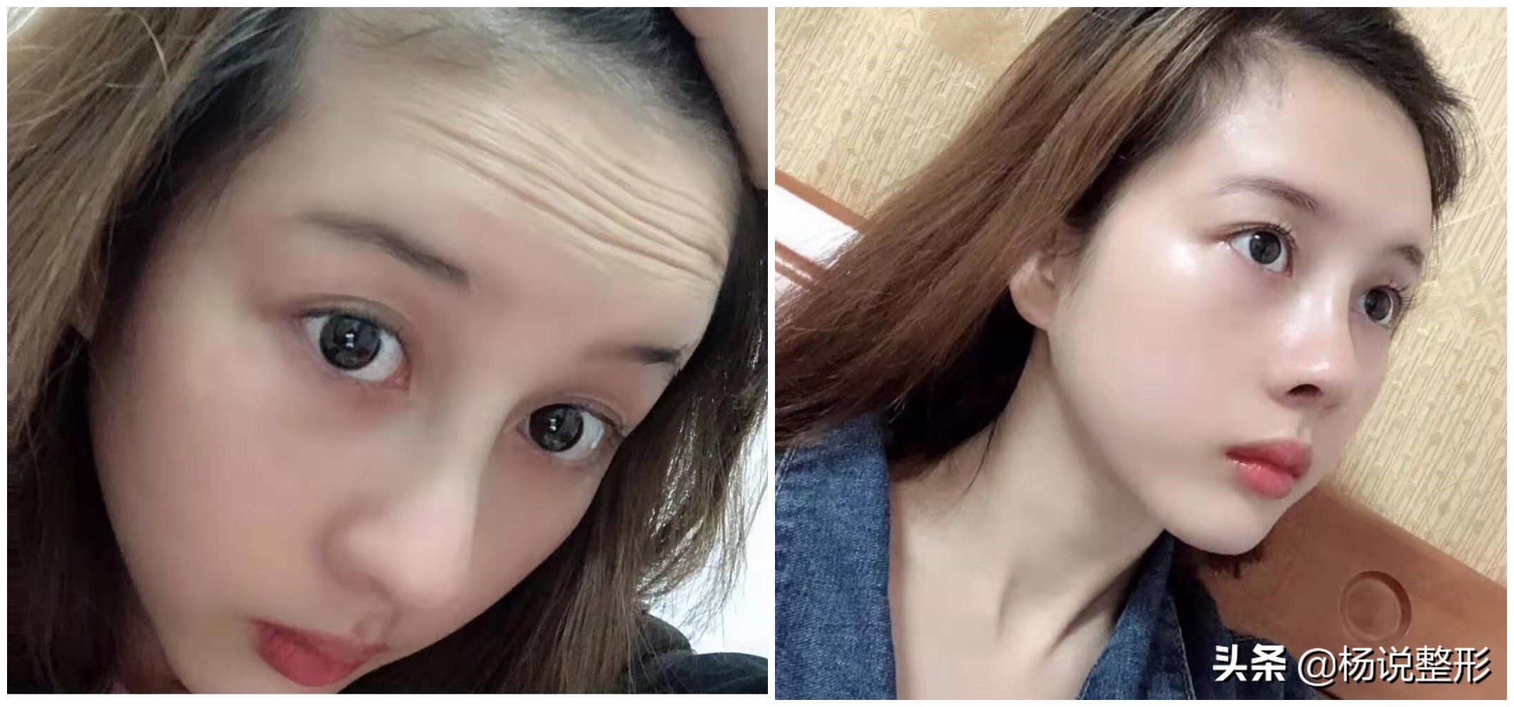 目前最有效的除皱方法,快速有效的除皱方法