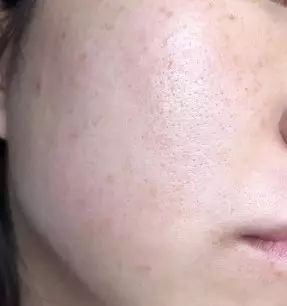 敏感肌可以做激光祛斑吗,激光祛斑问诊