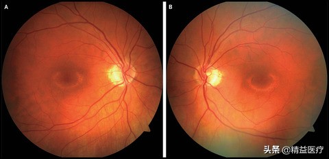 60岁女性眼睛一圈长黄斑怎么办,60岁女性一只眼睛有黑影怎么办