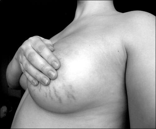 肥胖纹很严重怎么消除,有效去除肥胖纹的方法