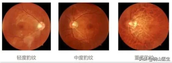 豹纹状眼底是什么原因引起的,近视眼都有豹纹状眼底吗