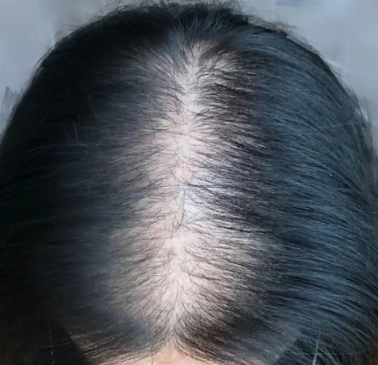 女性头发突然秃了一块,女性斑秃中医怎样调理