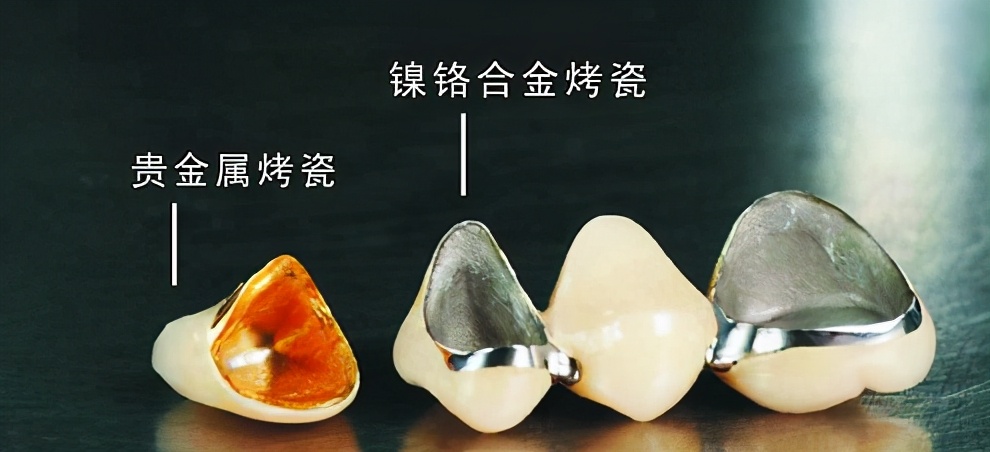 口腔金属冠与全瓷冠的区别,牙科医生讲义