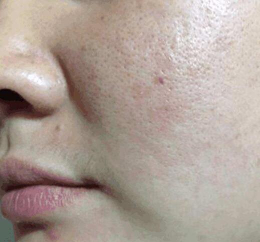 收缩毛孔最有效的方法真的有吗,收缩毛孔效果比较好的十种方法