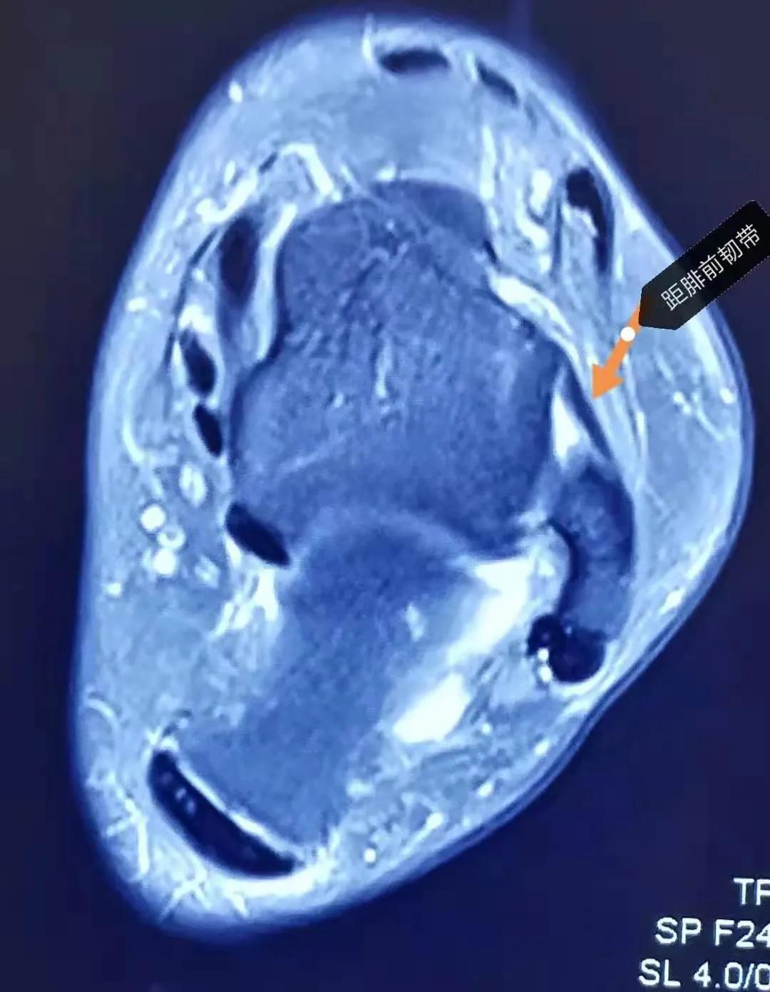 外踝扭伤怎么判断韧带是否恢复,外踝韧带损伤之后能彻底恢复吗